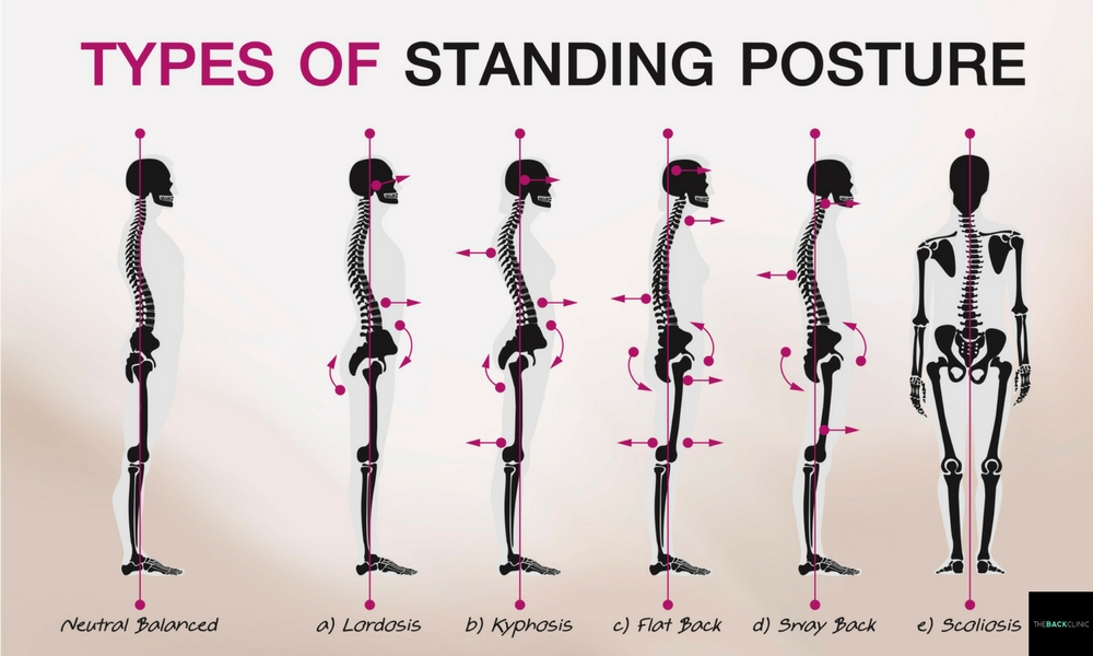 how-do-i-correct-prevent-sway-back-posture-thebackclinic-1