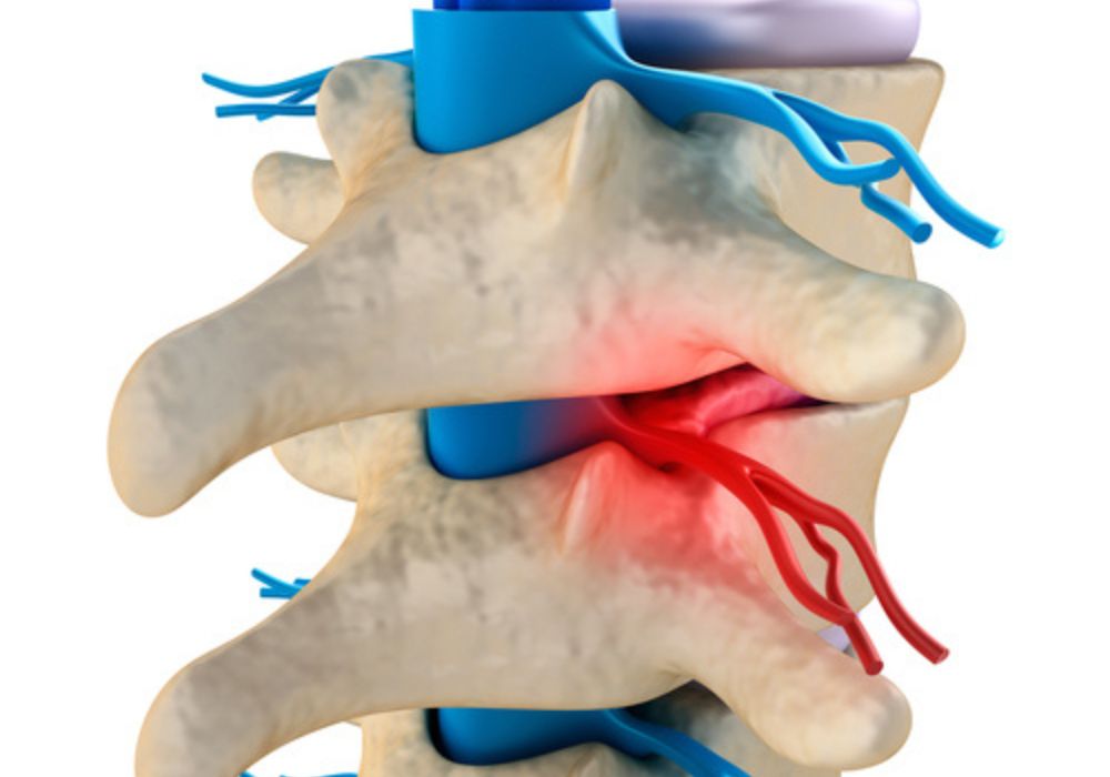 Chiropractor for Disc Bulge Chiropractor for Disc Bulge