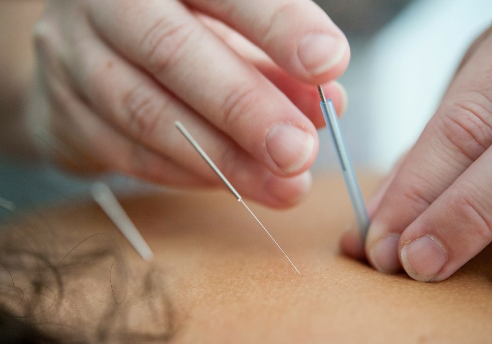dry needling sydney dry needling sydney